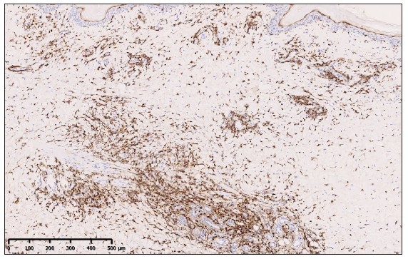 Immunohistochemistry showed positive staining for granzyme B of atypical cells (100x).